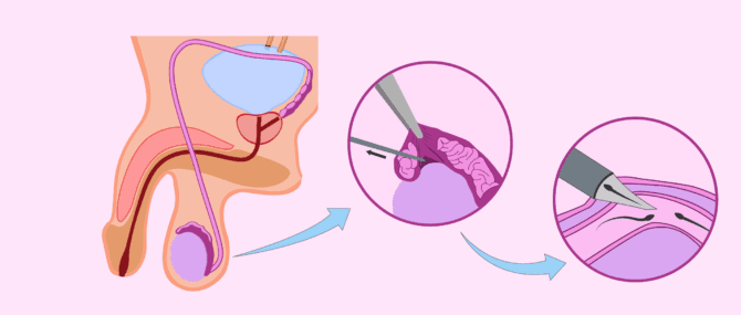Imagen: Aspiració microquirúrgica d'espermatozoides de l'epidídim (MESA)