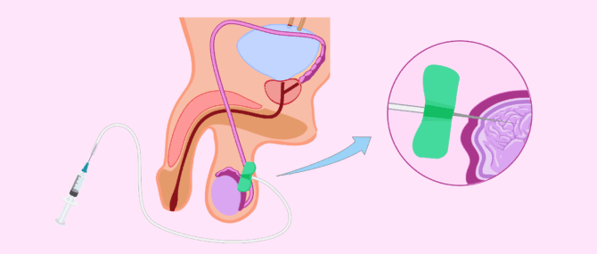 Imagen: Aspiració percutània d'espermatozoides d'epidídim (PESA)