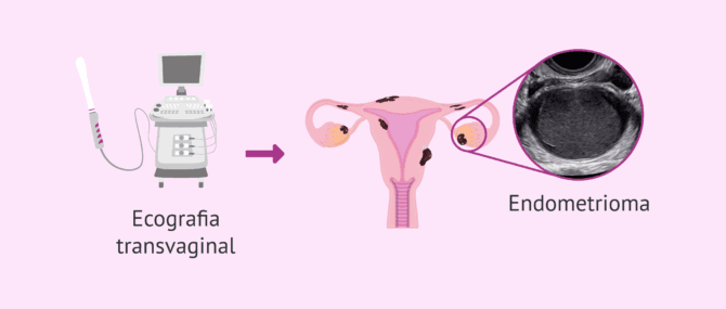 Imagen: Ecografia transvaginal per detectar quists de xocolata