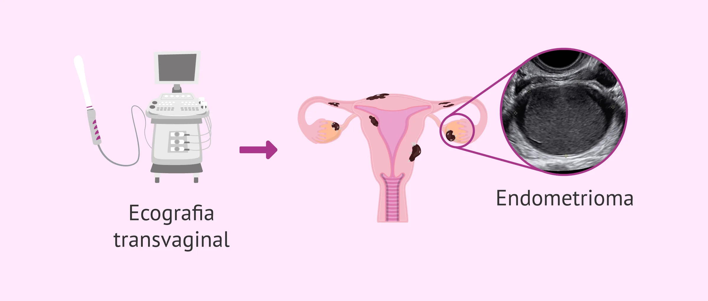Diagnòstic de l'endometriosi: analítiques i proves d'imatge