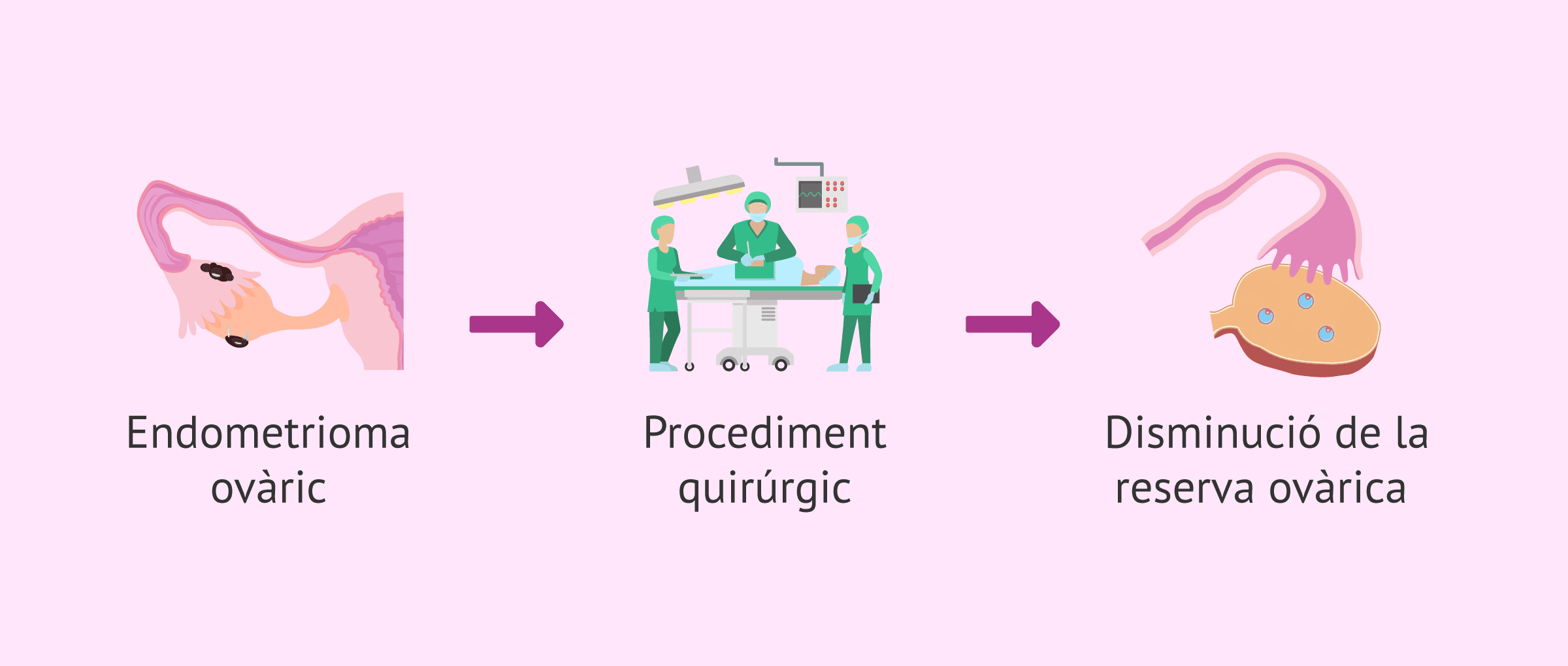 Cirurgia d'endometrioma: tècniques que cuiden la reserva ovàrica