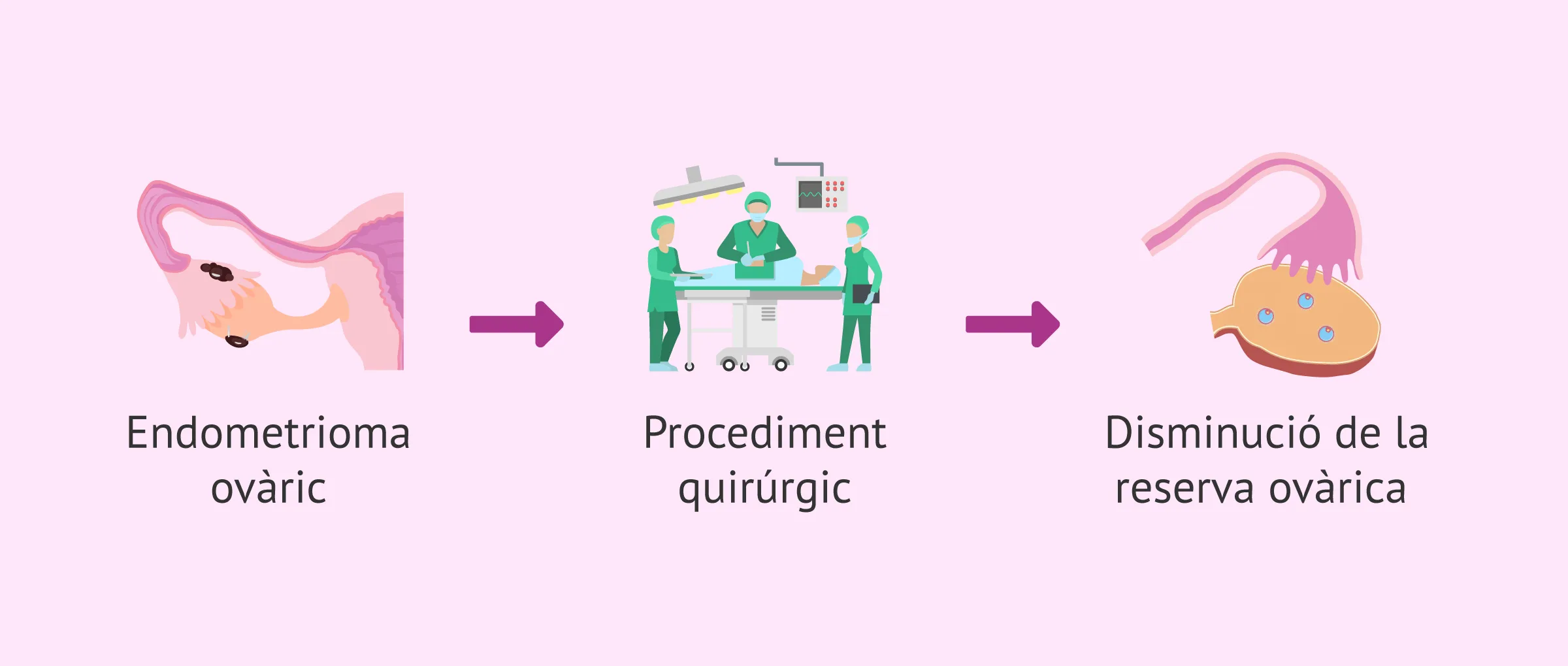 Cirurgia d'endometrioma: tècniques que cuiden la reserva ovàrica