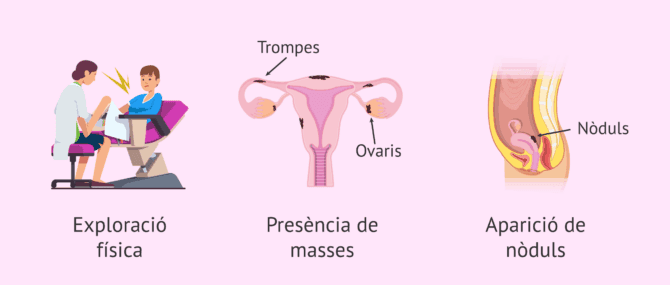 Imagen: Què pot ser indicatiu de l'endometriosi?