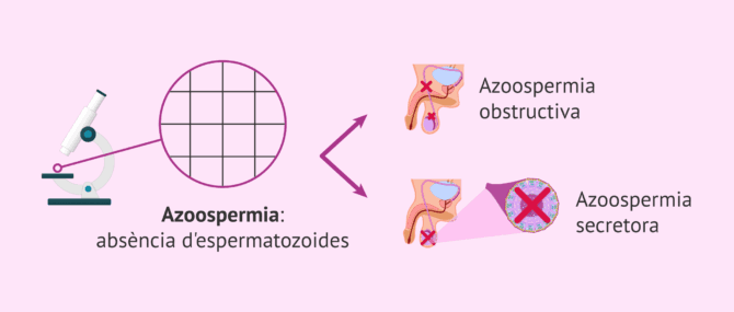 Imagen: Com pot ser l'azoospèrmia?