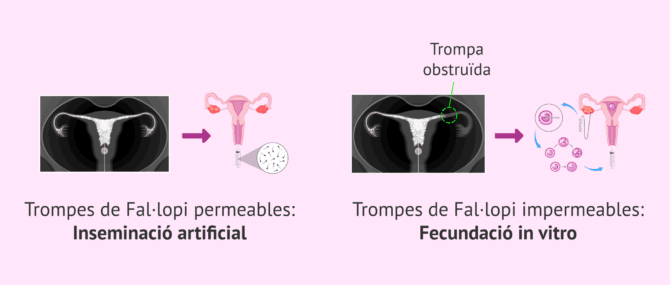 Imagen: Tractament de fertilitat segons el resultat de la HSG