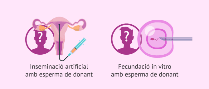 Imagen: Donació de semen com a solució per a l'azoospèrmia