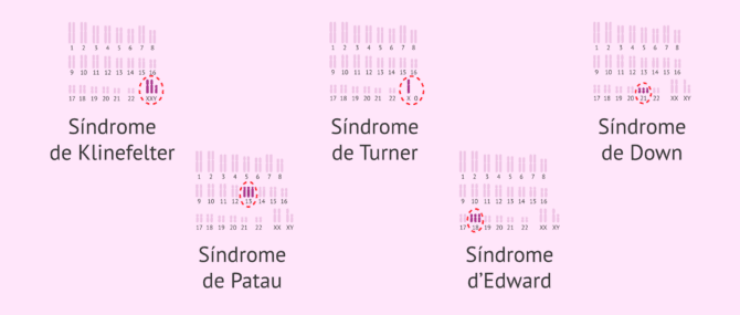Imagen: Alteracions cromosòmiques numèriques