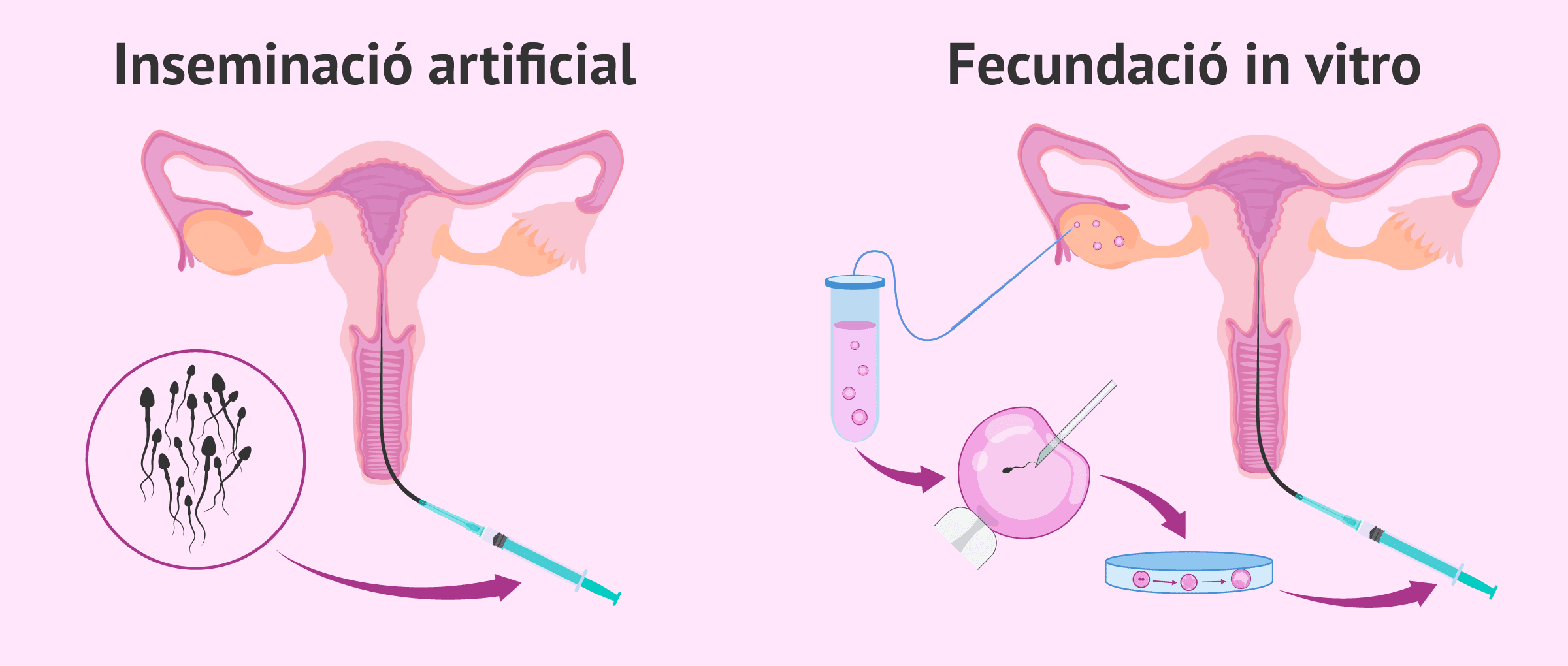Diferències entre inseminació artificial i fecundació in vitro