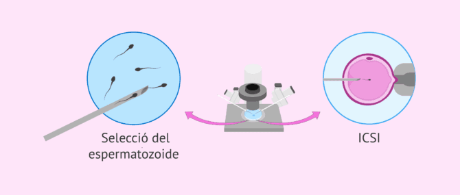 Imagen: Oligoastenoteratospèrmia i reproducció assistida