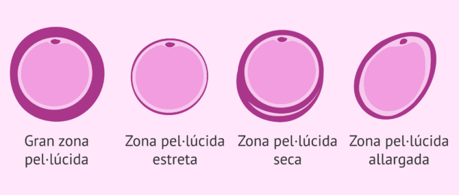 Imagen: Alteracions de la zona pel·lúcida en els ovòcits