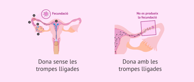 Imagen: Diferències en una dona amb les trompes lligades i una altra que no