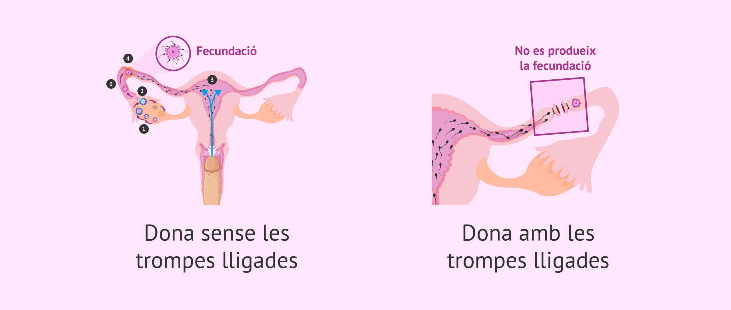 Possibilitat d'embaràs amb una lligadura de trompes de Fal·lopi