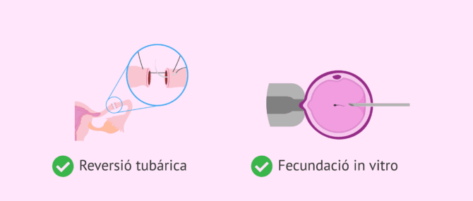 Imagen: Opcions d'embaràs després d'una lligadura de trompes