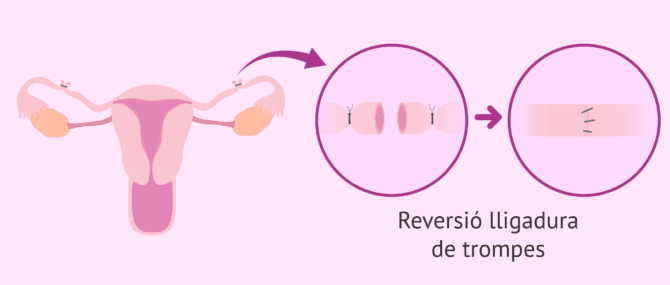 Imagen: Reversió de la lligadura de trompes