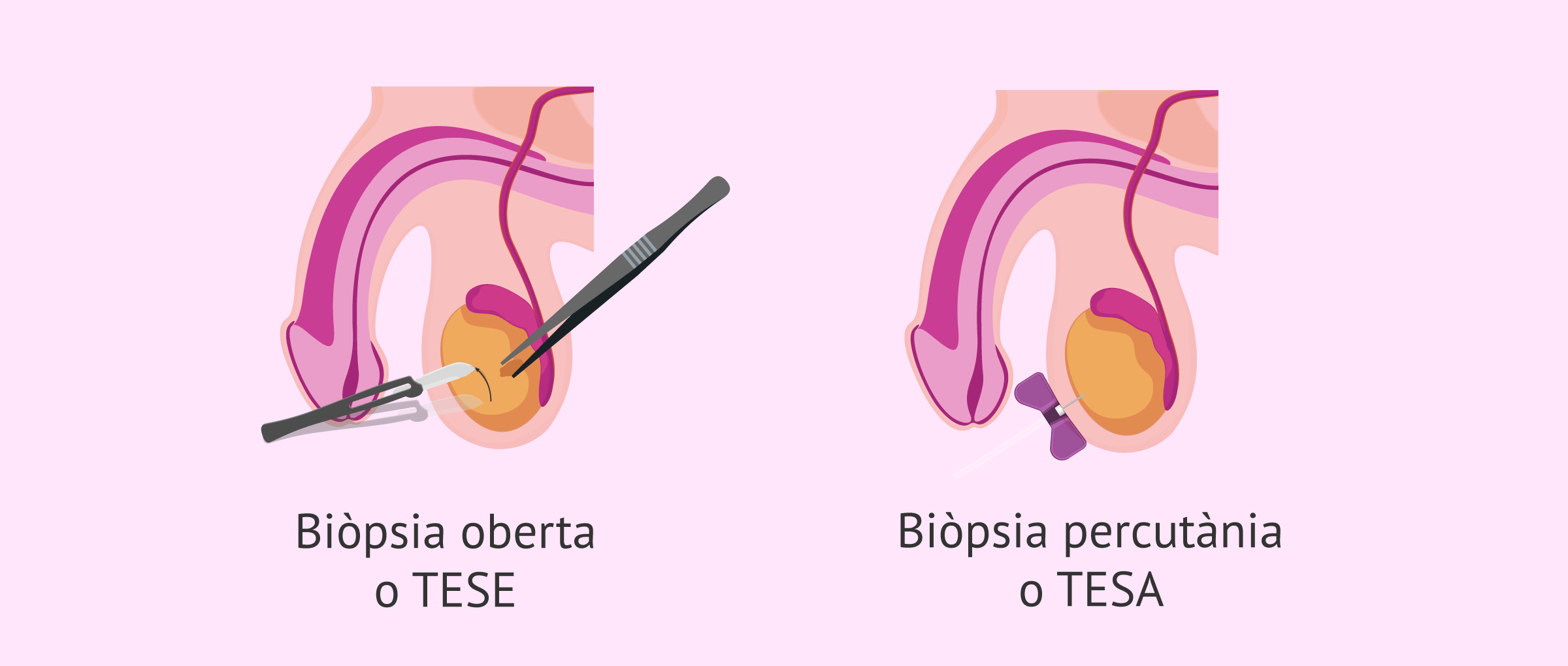 Mètodes per a realitzar la biòpsia testicular