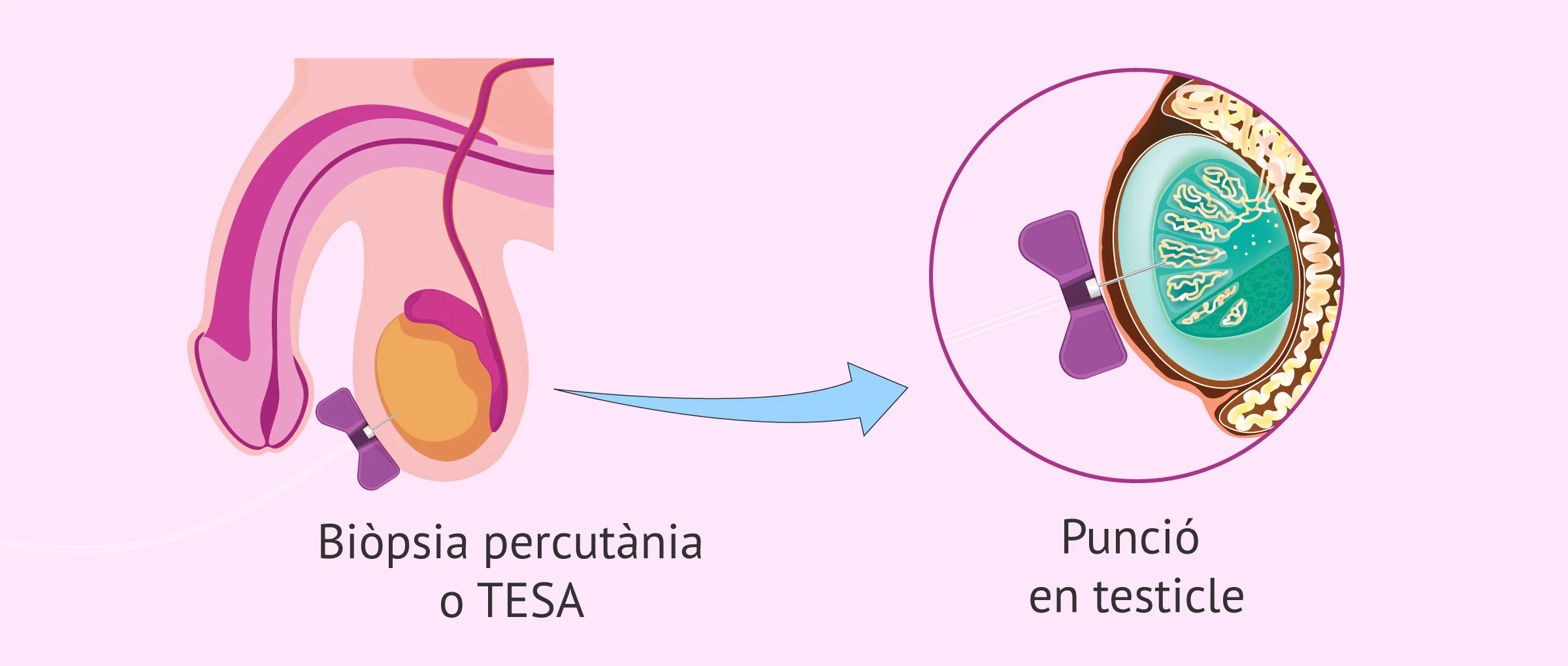 Imagen: Biospia percutània testicular (TESA)