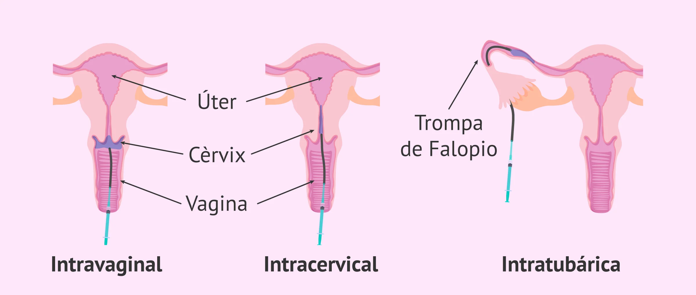 Imagen: Tipus de IA segons el lloc de dipositar el semen