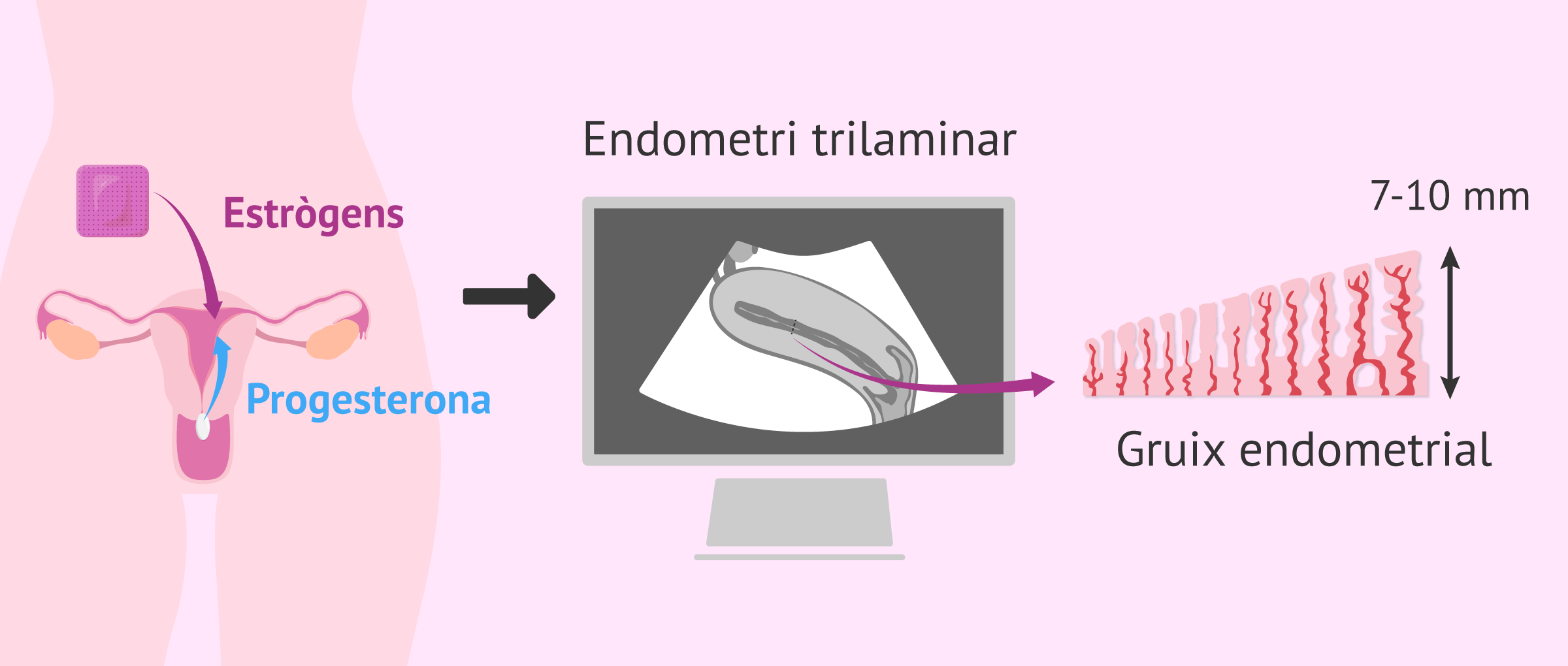 Preparació endometrial per a la transferència