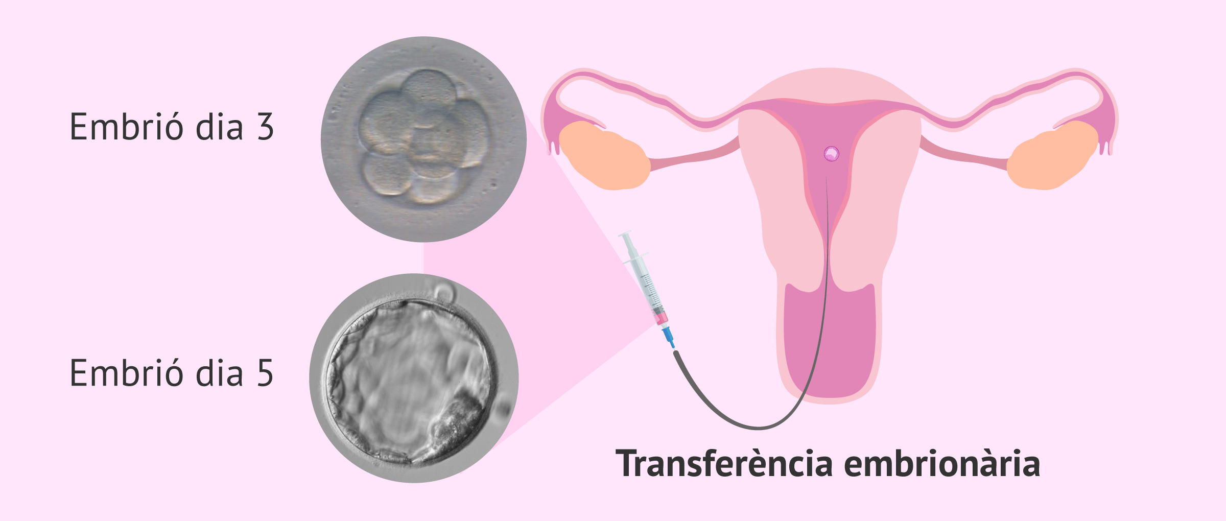 Transferència d'embrions a l'úter matern