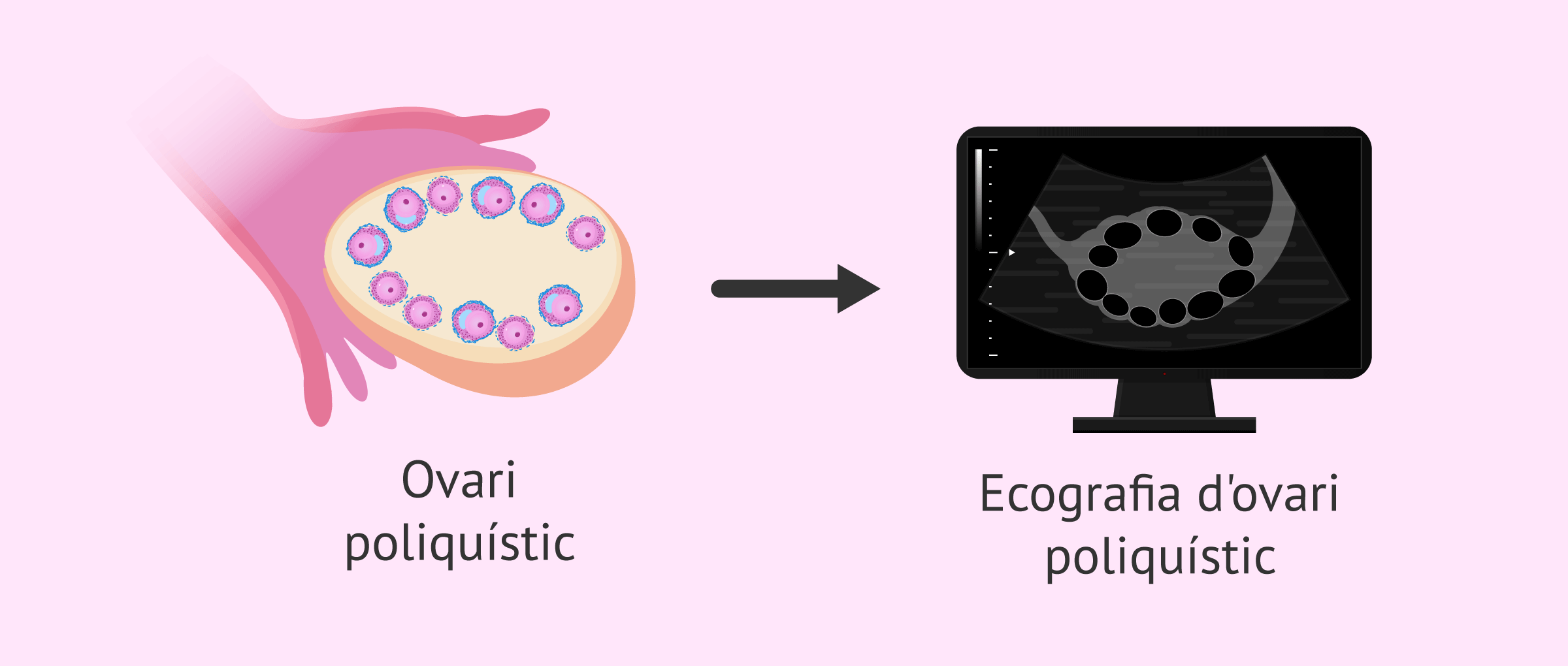 Ecografia d'ovari poliquístico