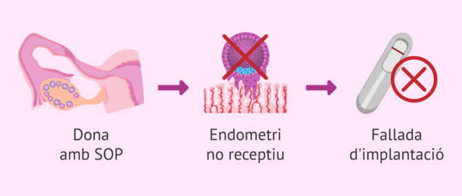 Imagen: Les dones amb SOP tenen endometri receptiu?