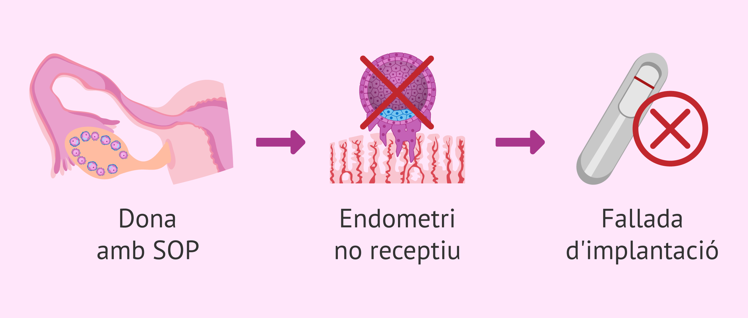 Les dones amb SOP tenen endometri receptiu?