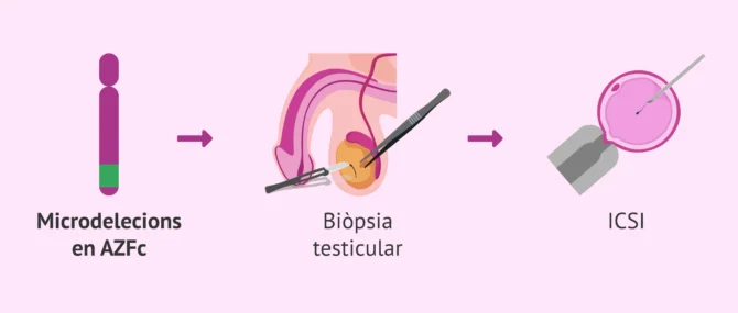 Imagen: Tècniques de reproducció assistida amb microdelecions en el cromosoma Y