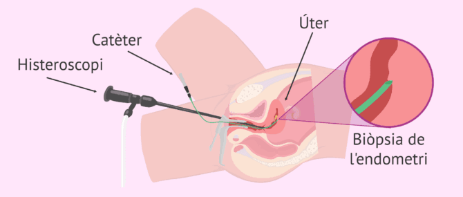 Imagen: Com es realitza una raspat d'endometri?