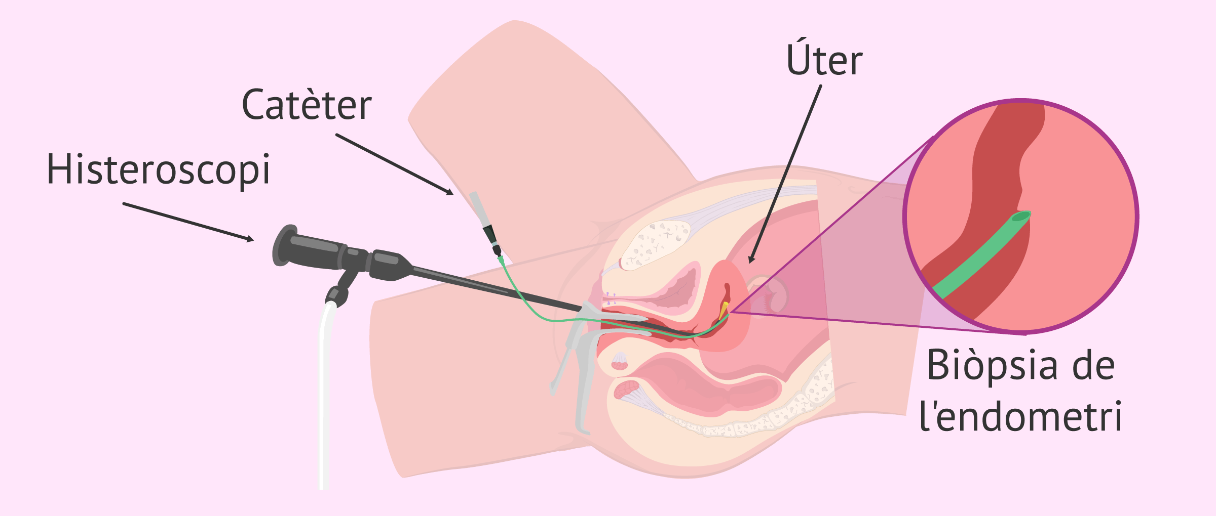 Què és l'scratching endometrial? – Indicacions i procediment