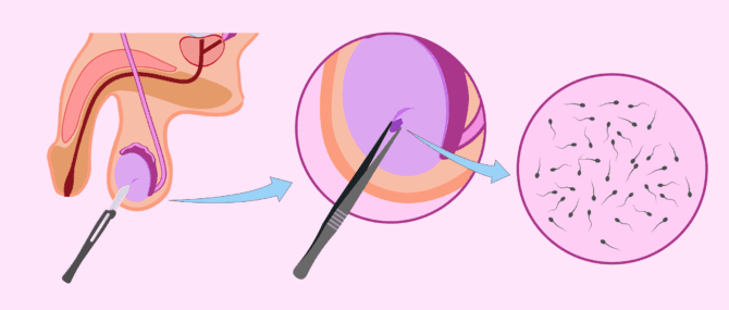Imagen: Biòpsia de testicle