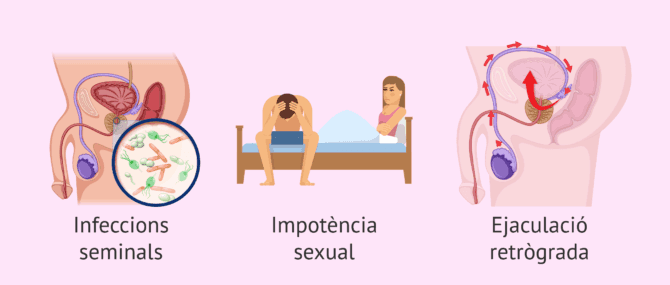 Imagen: Causes d'infertilitat per factor postesticular