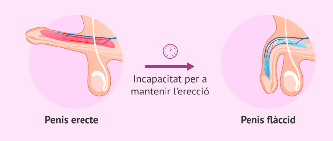 Imagen: Què és la impotència sexual?