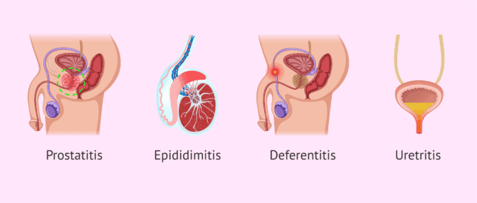 Imagen: Quines infeccions seminals existeixen?