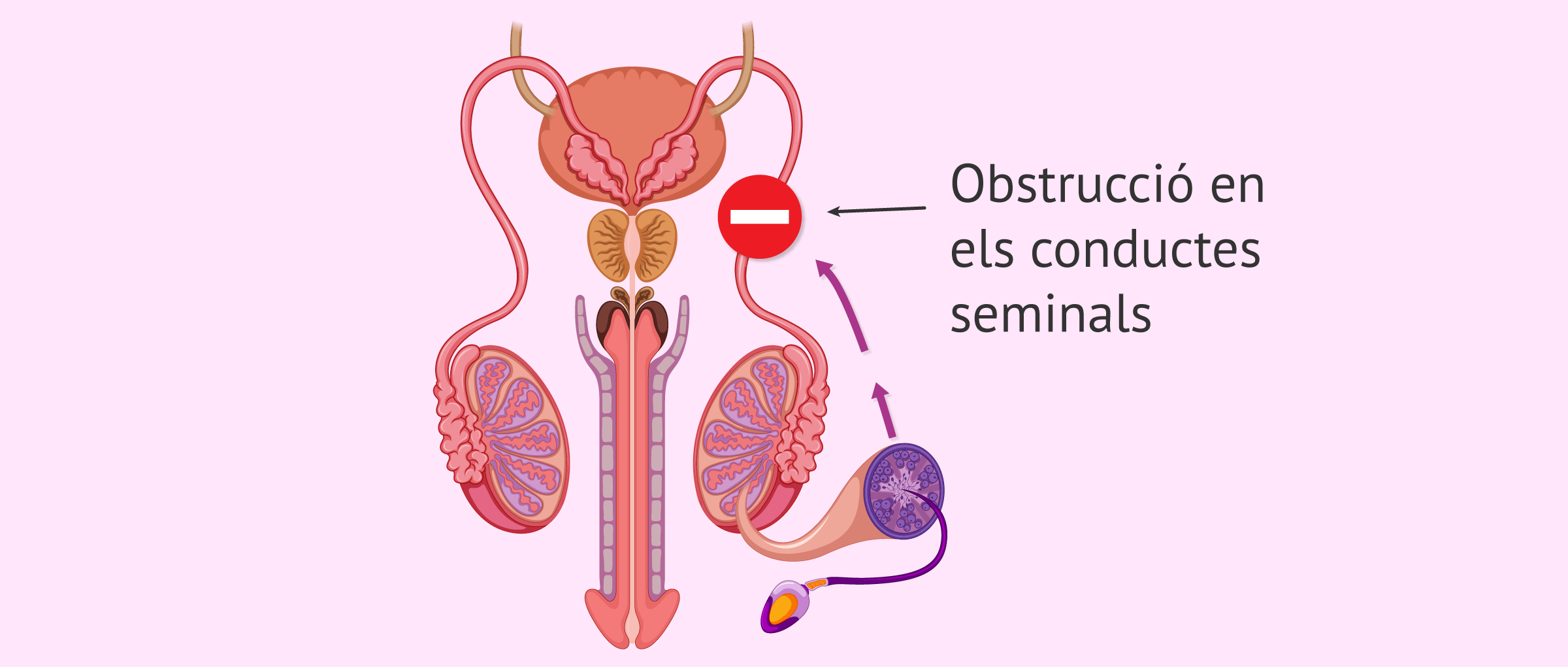 Què és l'esterilitat masculina deguda a un factor posttesticular?