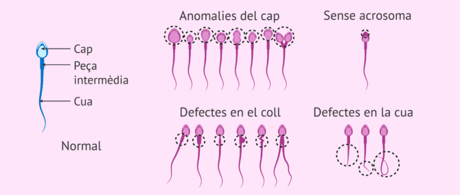 Imagen: Què és un espermatozoide anormal?