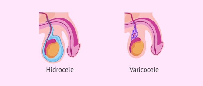 Imagen: Diferències entre hidrocele i varicocele