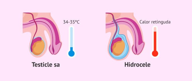 Imagen: Hidrocele i temperatura testicular