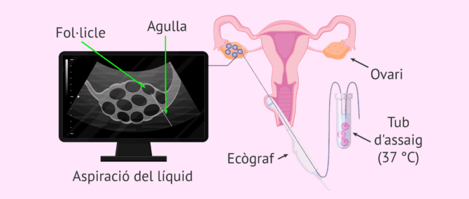 Imagen: Aspiració fol·licular o punció ovàrica