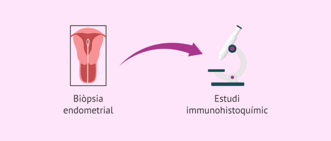 Imagen: Problemes per al diagnòstic de l'endometritis crònica