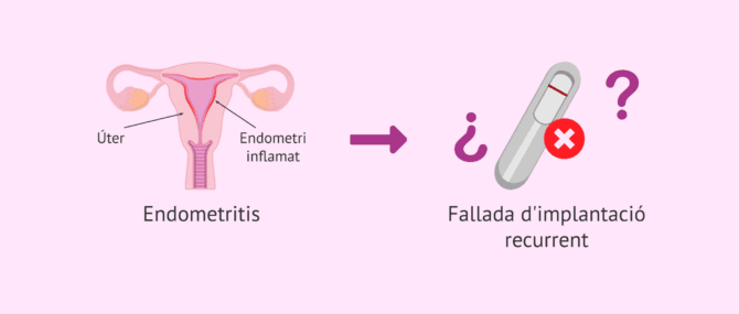 Imagen: Endometritis crònica i la seva implicació en la fallada d'implantació