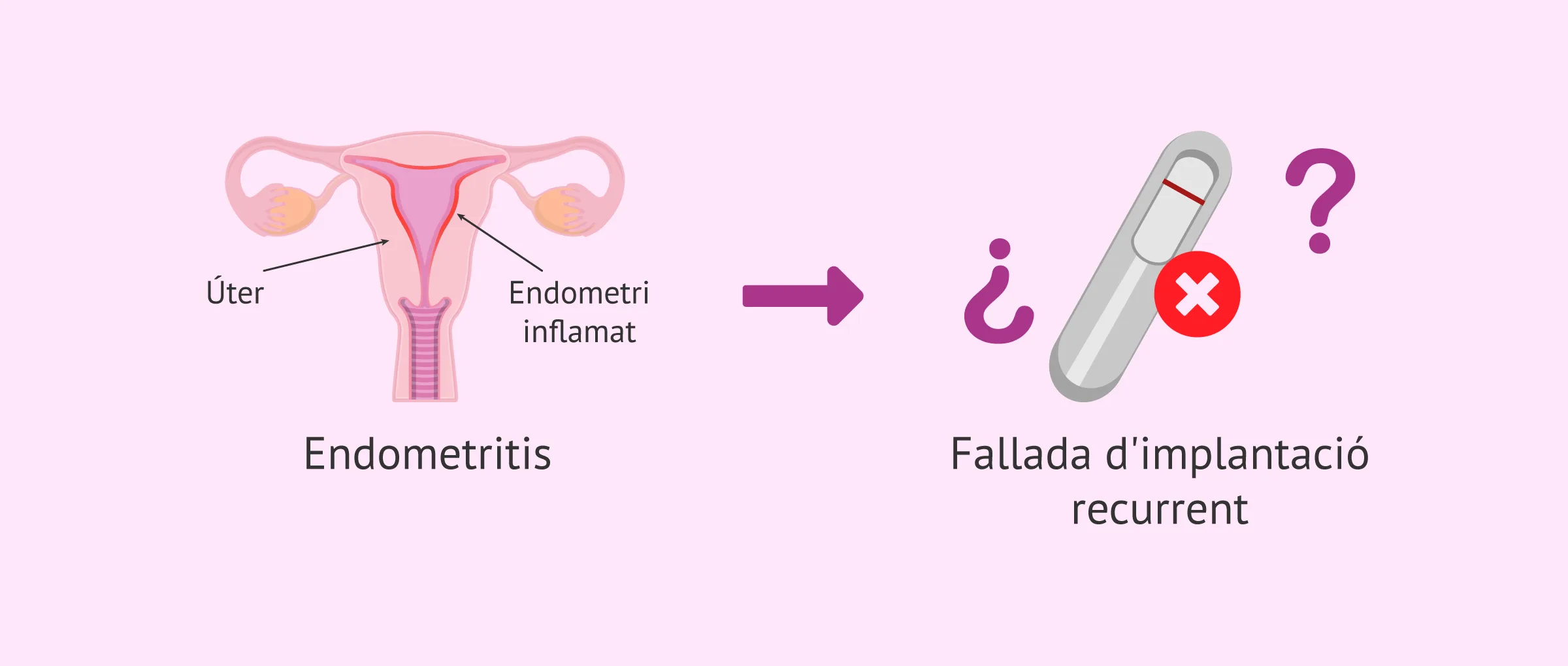 Endometritis crònica: la gran veritat en la fallada d'implantació