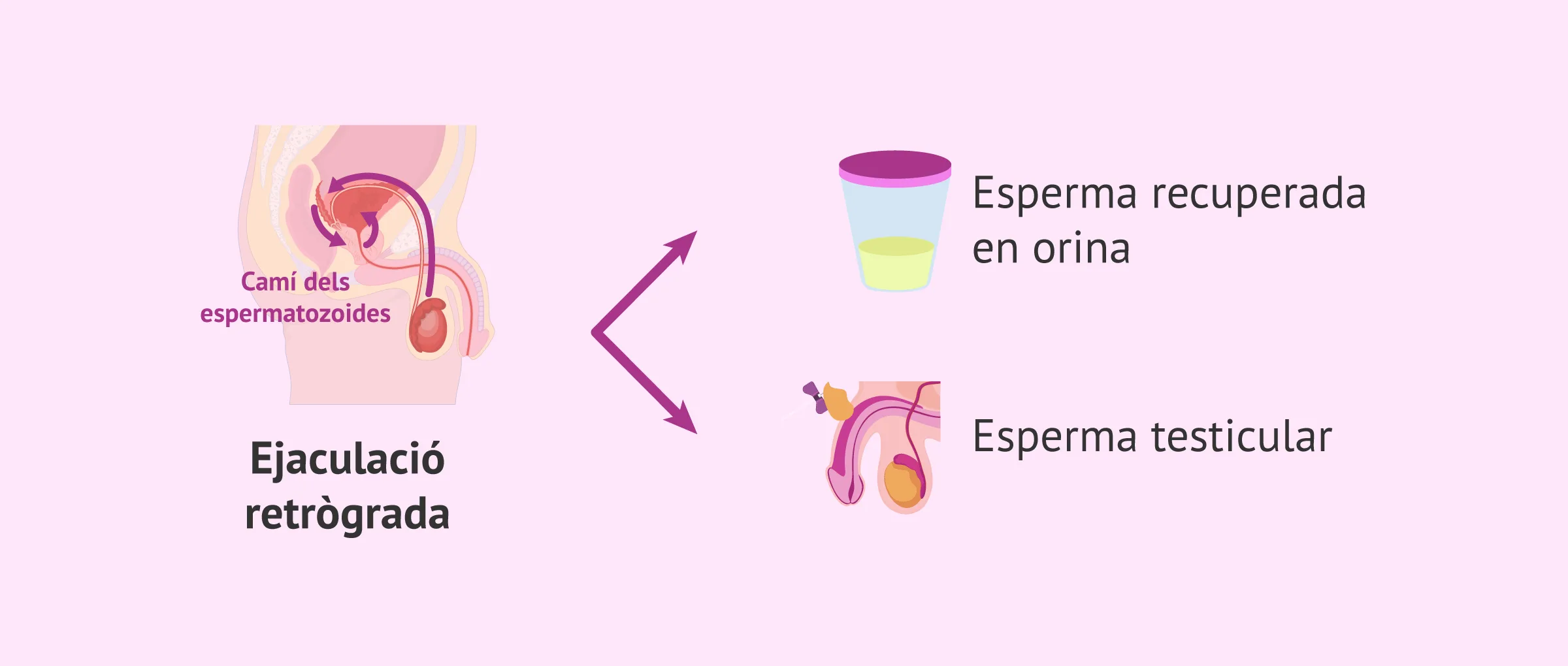 Obtenir espermatozoides amb ejaculació retrògrada