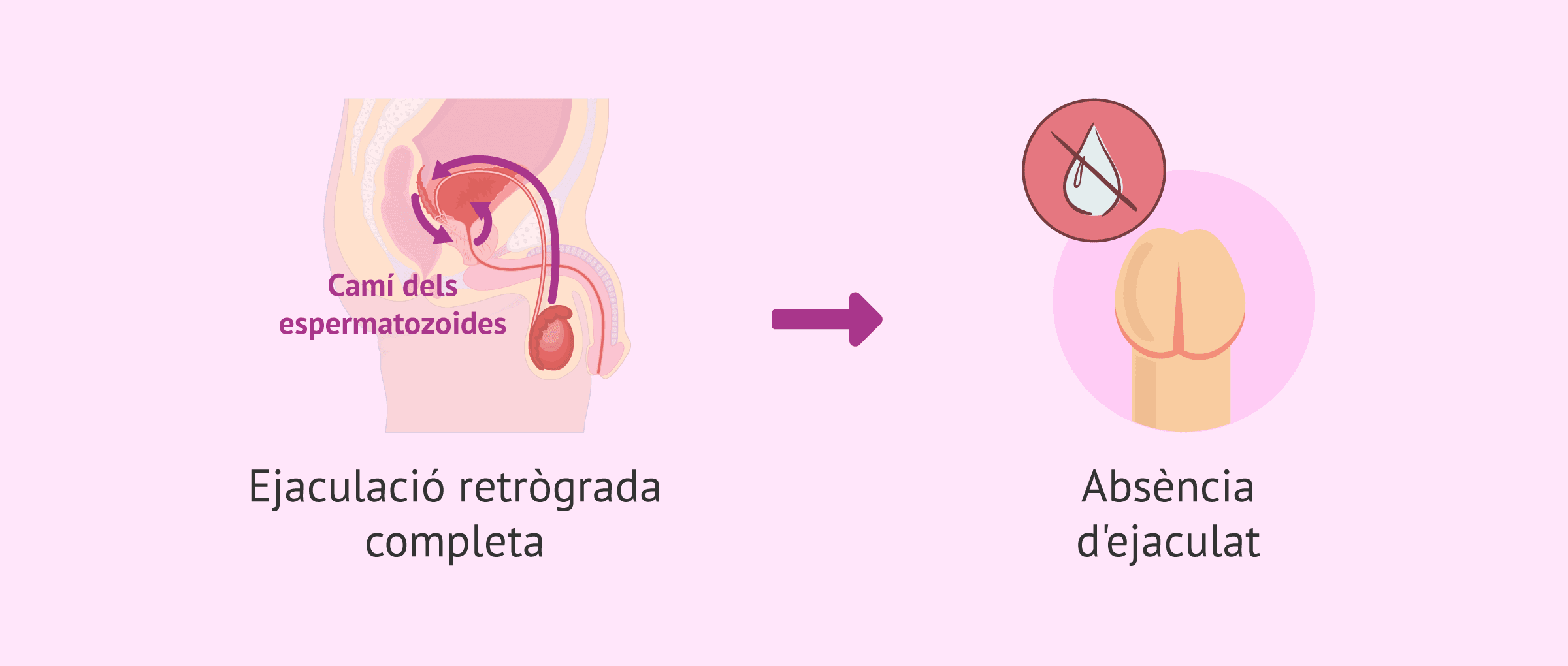 Imagen: Conseqüències de l'ejaculació retrògrada completa