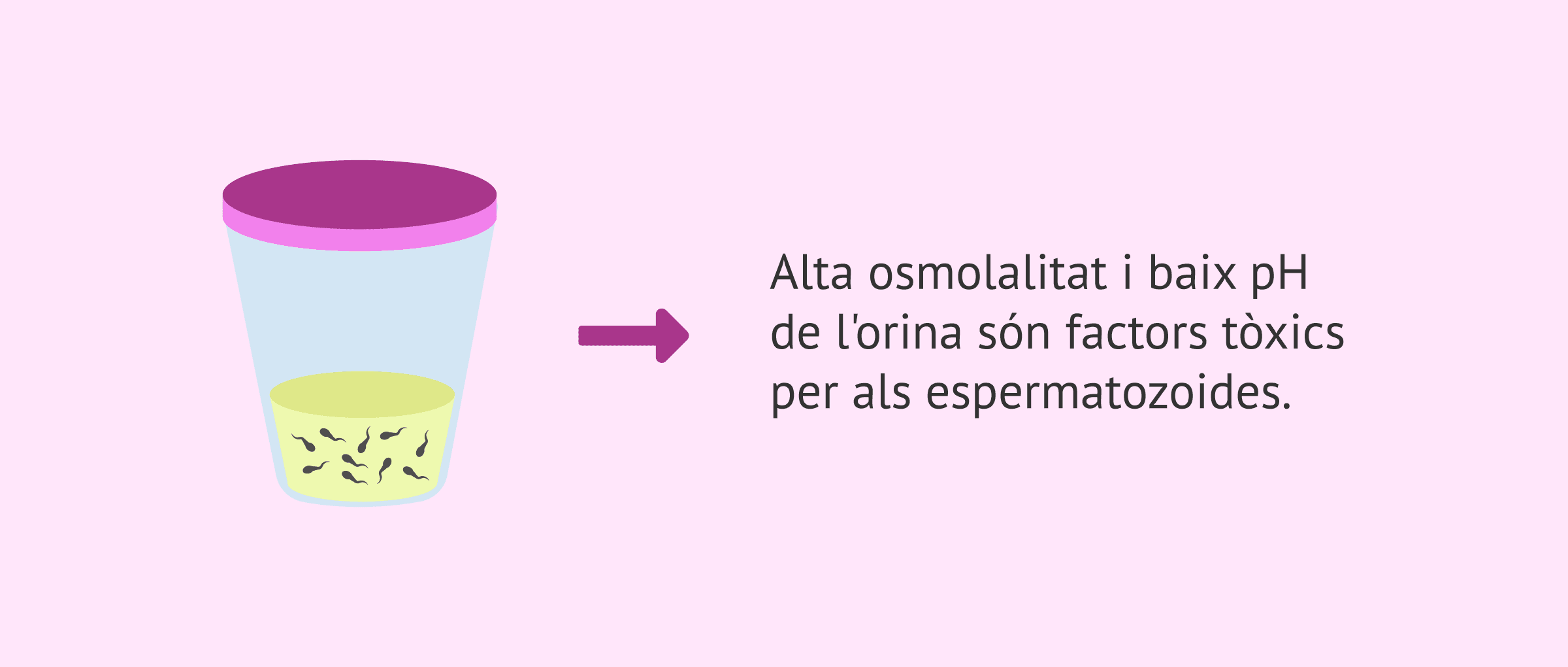 Imagen: Espermatozoides a l'orina després de l'ejaculació retrògrada